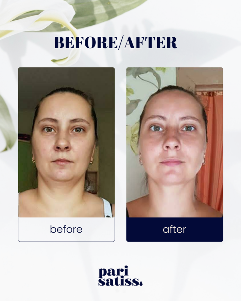 Gua Sha massage results